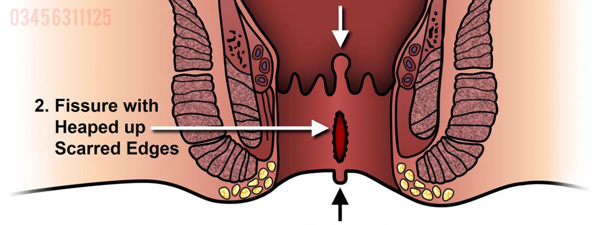 Anal Fissure Causes, Symptoms and Treatment