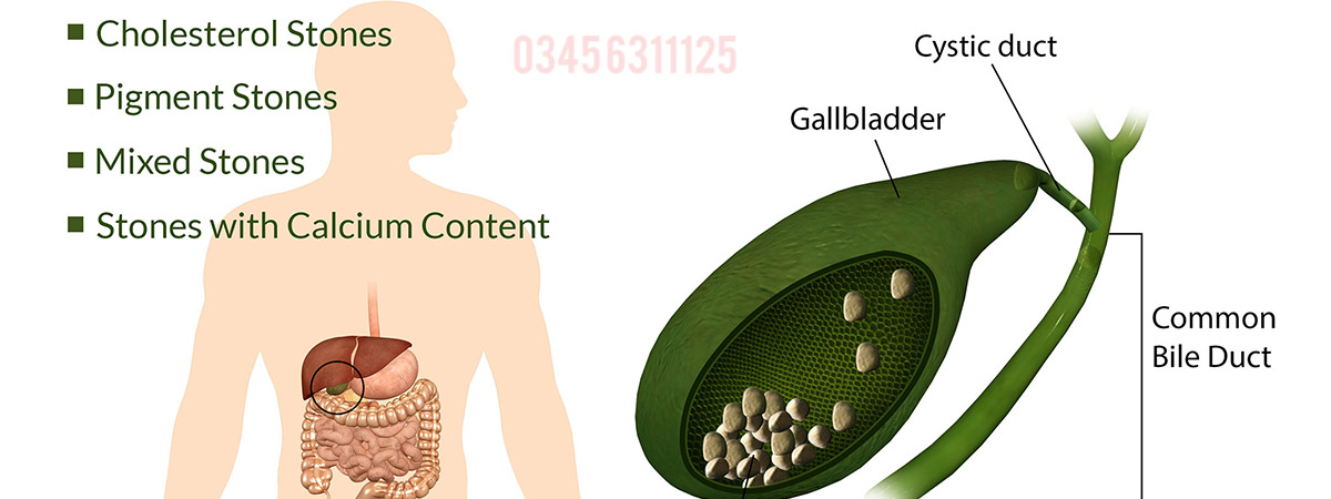 Gallstones Causes, Symptoms and Treatment