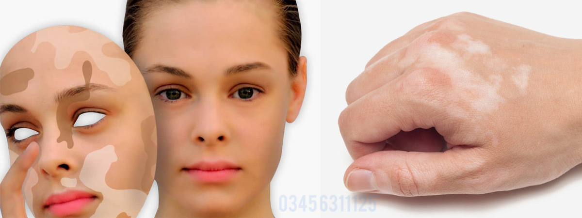 Vitiligo Causes, Symptoms and Treatment