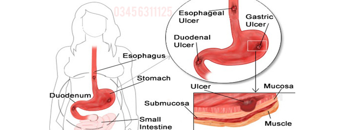 Peptic Ulcers Causes, Symptoms and Treatment